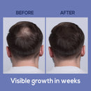 Ein Vorher-Nachher-Vergleich des Hinterkopfs eines Mannes auf lila Hintergrund. Das „BEFORE“-Bild zeigt sichtbare Haarverdünnung am Scheitel, während das „AFTER“-Bild diesen Bereich mit dichterem, dunkelbraunem Haar bedeckt zeigt.
