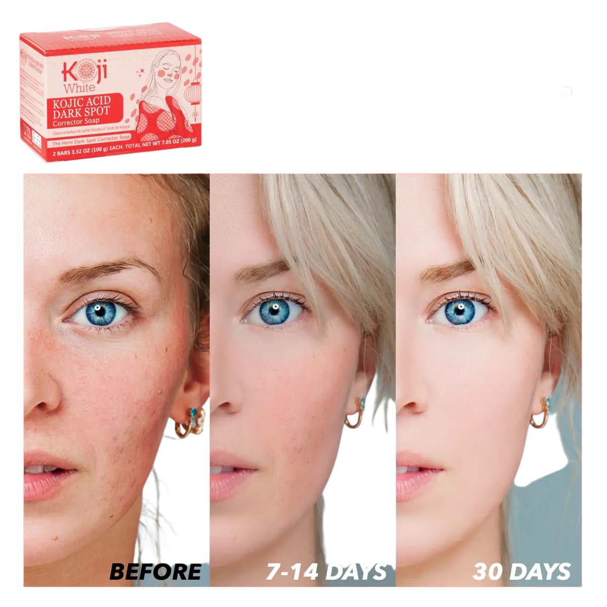 Koji White Kojic Acid Seife zur Behandlung dunkler Flecken, sichtbare Textur und dunkle Farbe, für eine klare Haut.